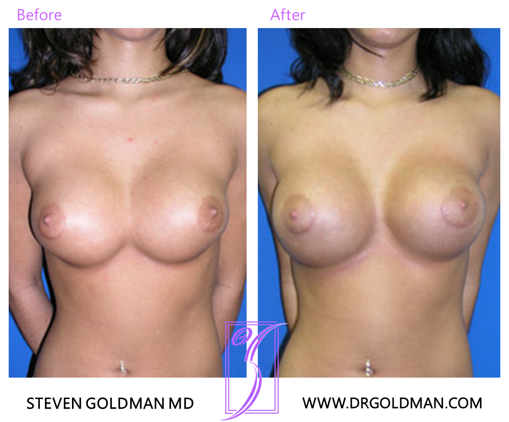 Revision Breast Augmentation