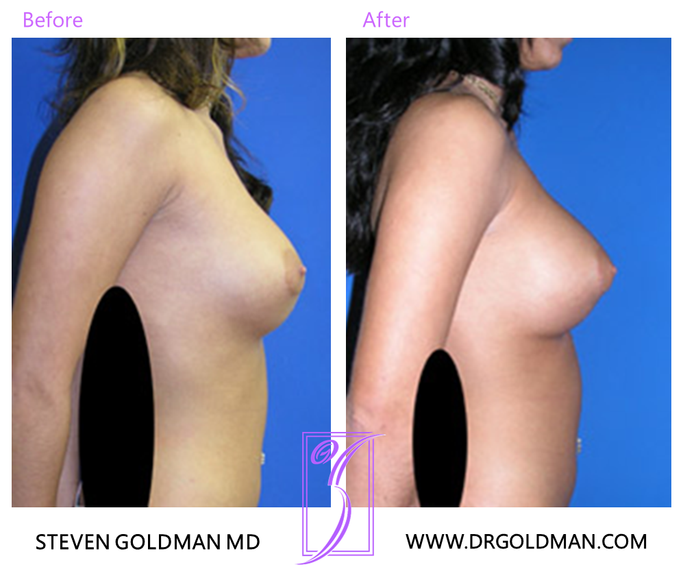 Revision Breast Augmentation