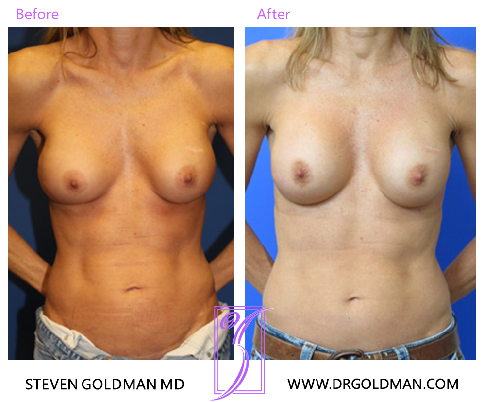 Revision Breast Augmentation