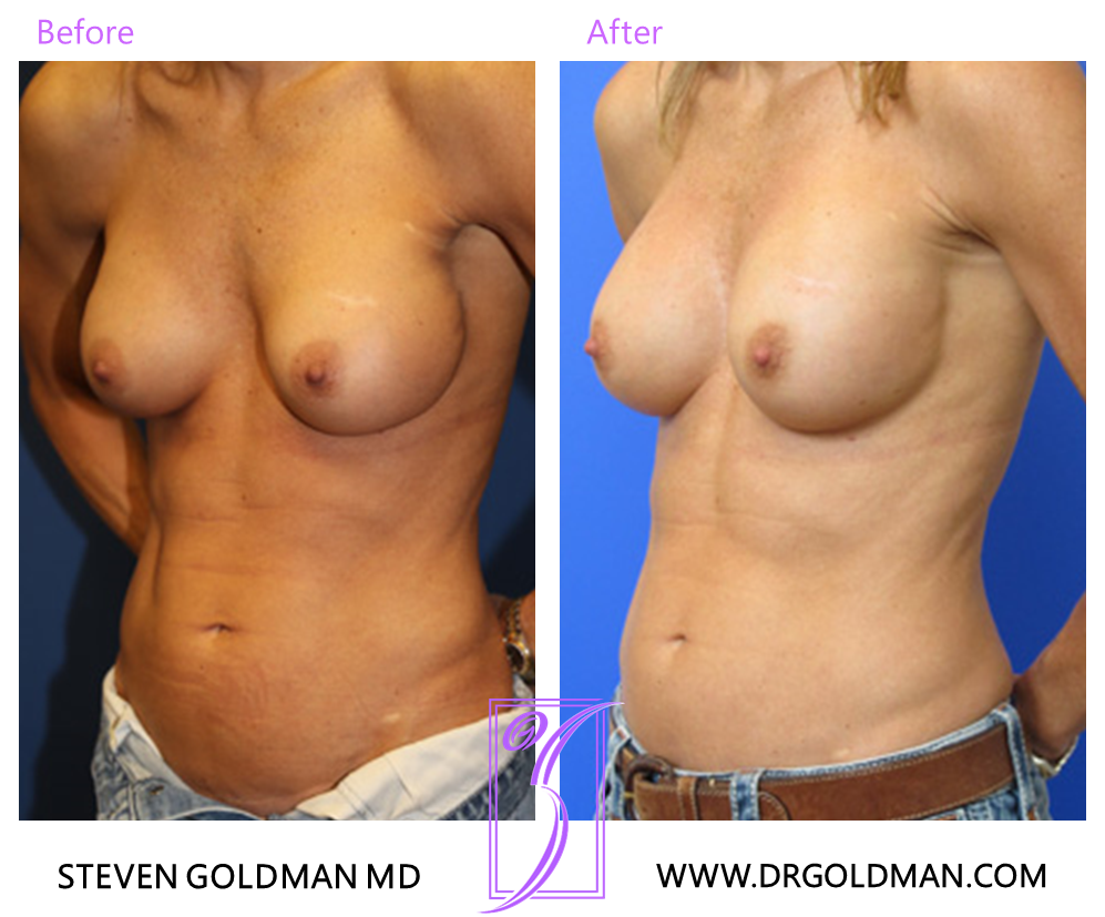 Revision Breast Augmentation