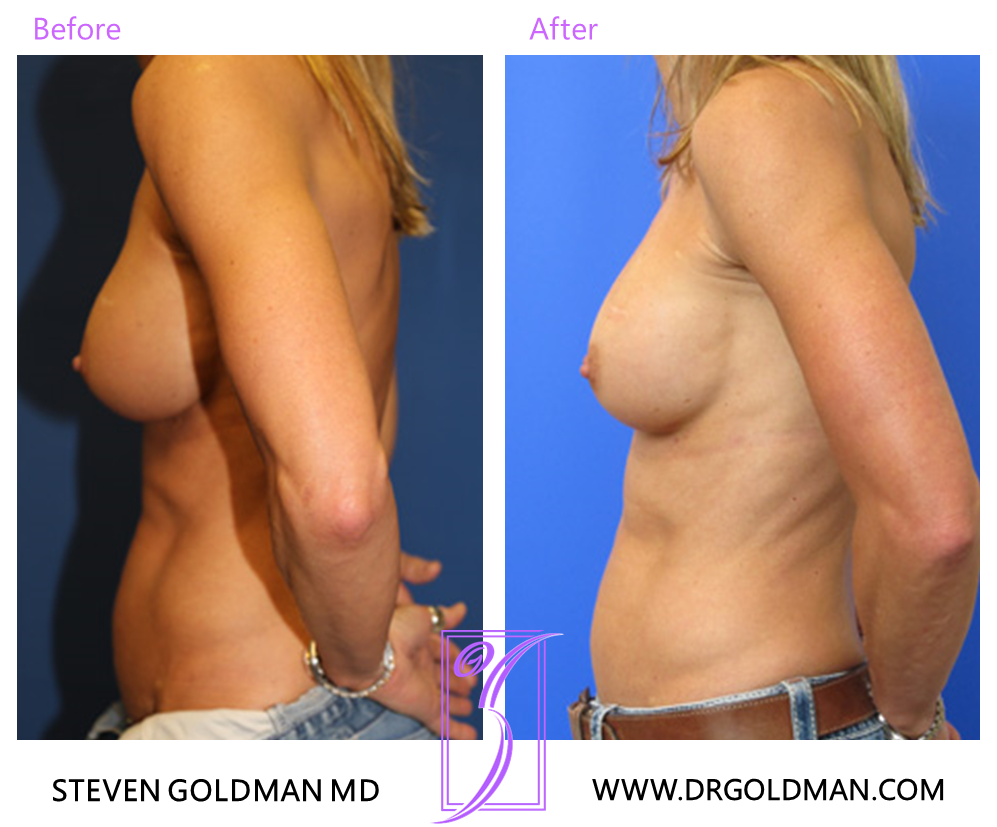 Revision Breast Augmentation
