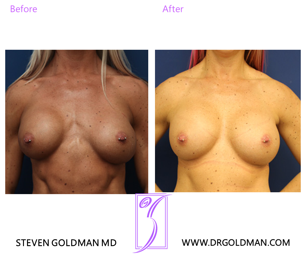 Revision Breast Augmentation