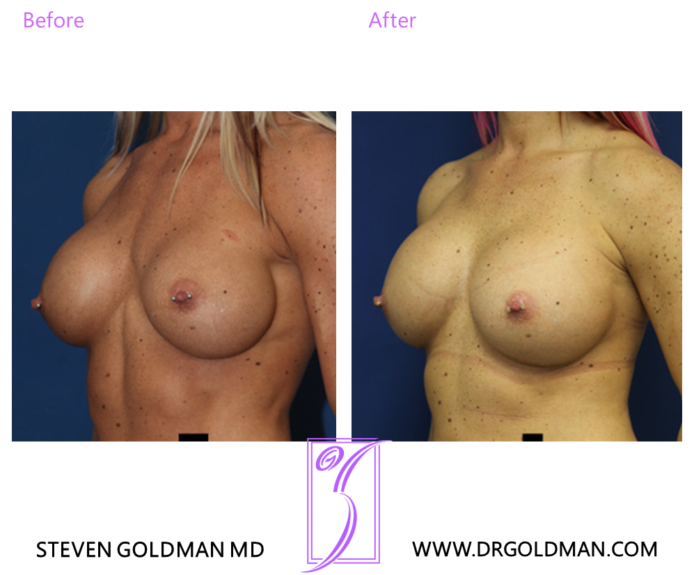 Revision Breast Augmentation