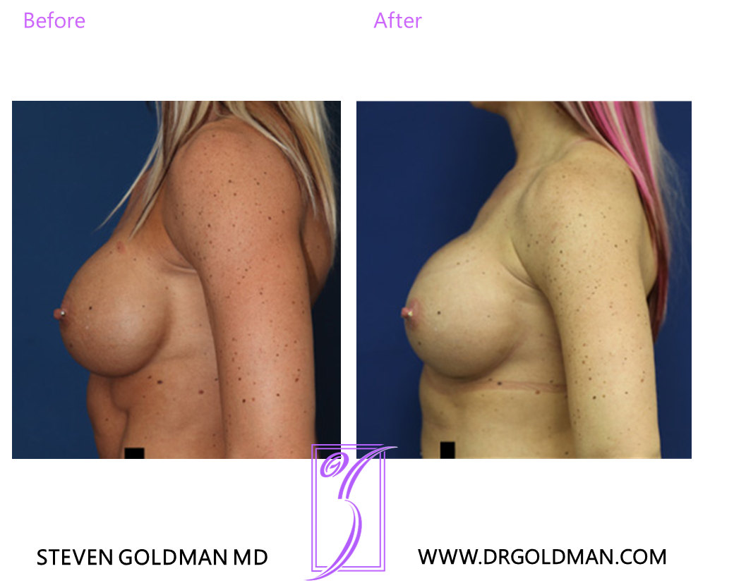 Revision Breast Augmentation