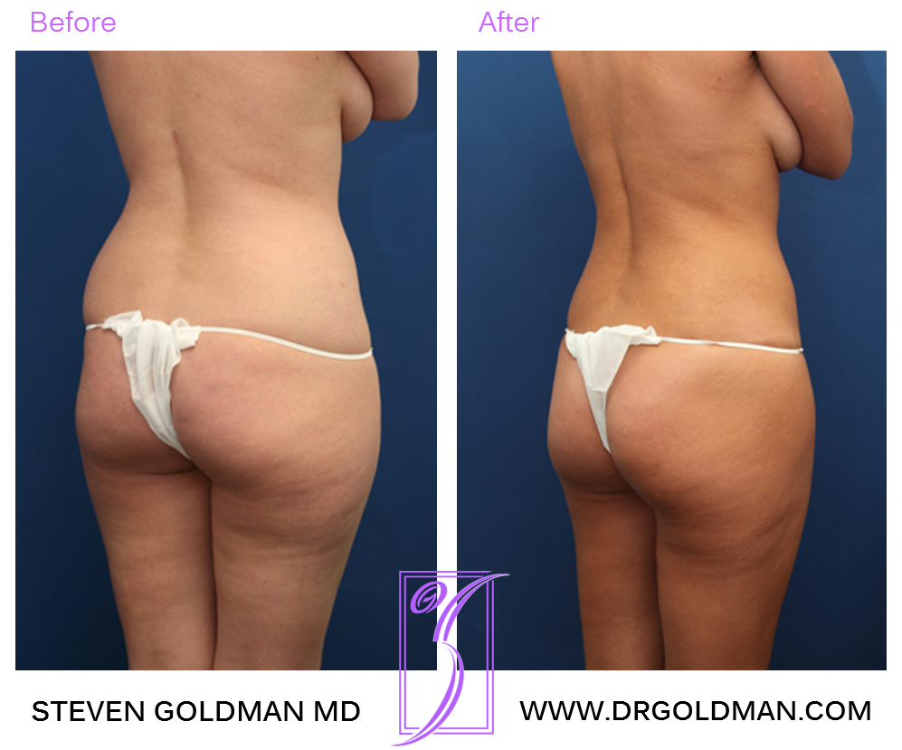 Liposuction