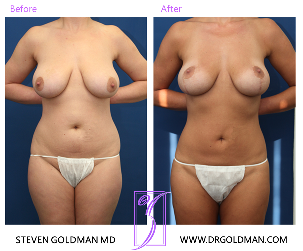 Liposuction