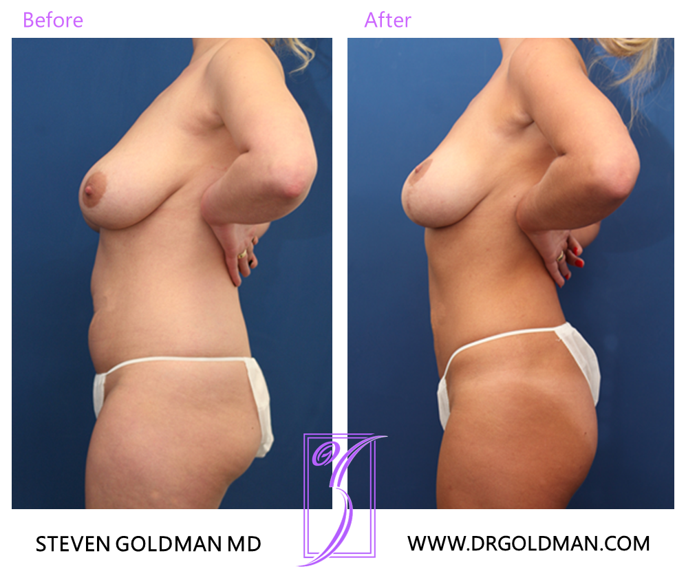 Liposuction