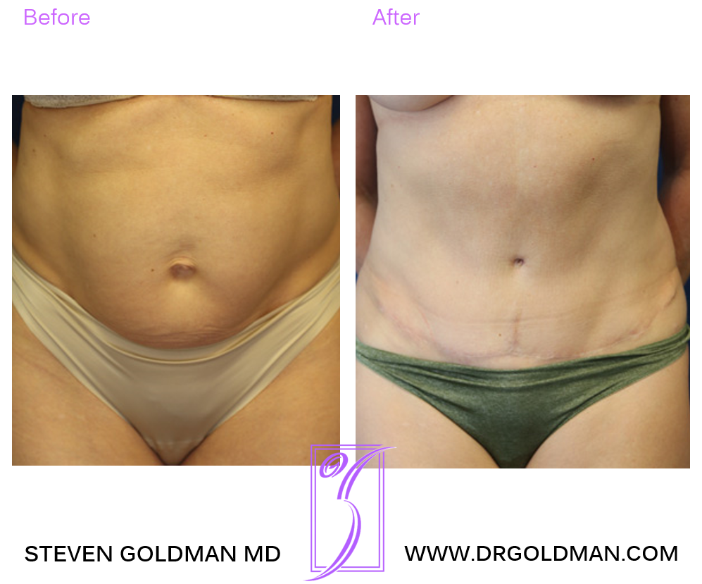 Abdominoplasty