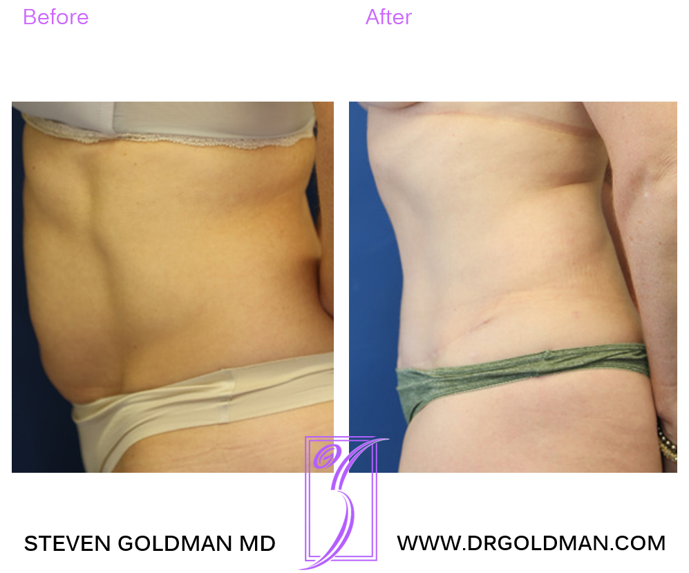 Abdominoplasty