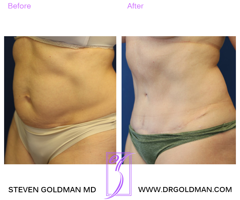 Abdominoplasty
