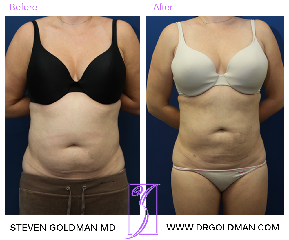 Liposuction