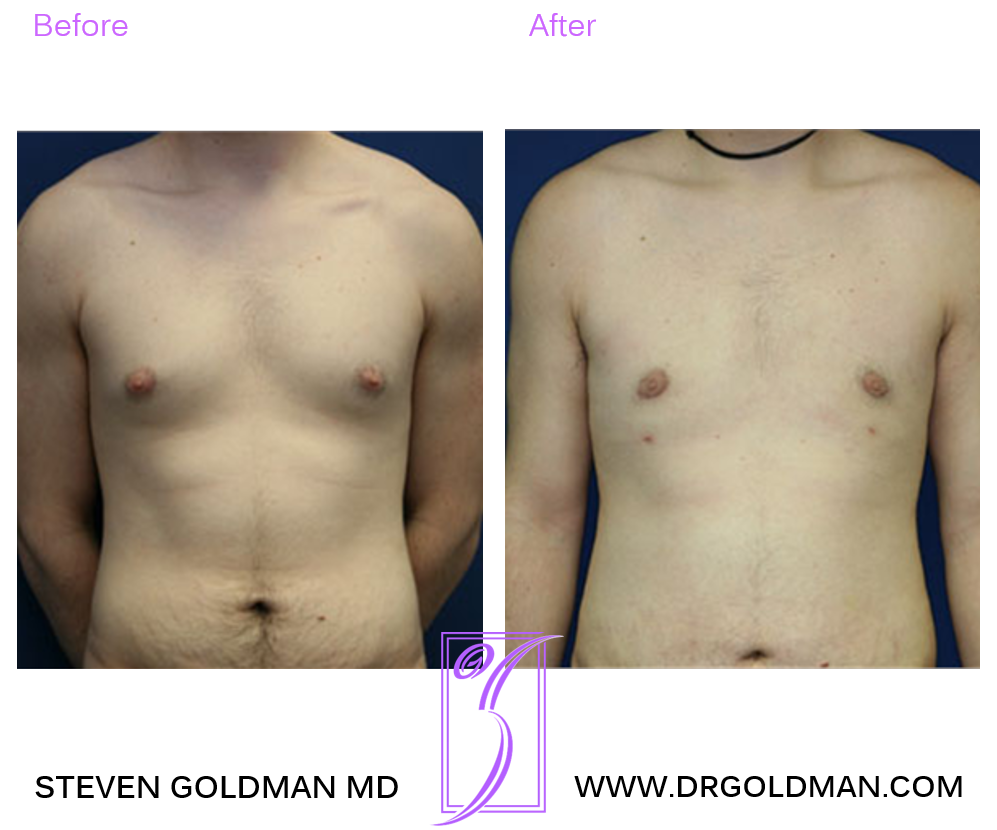 Gynecomastia