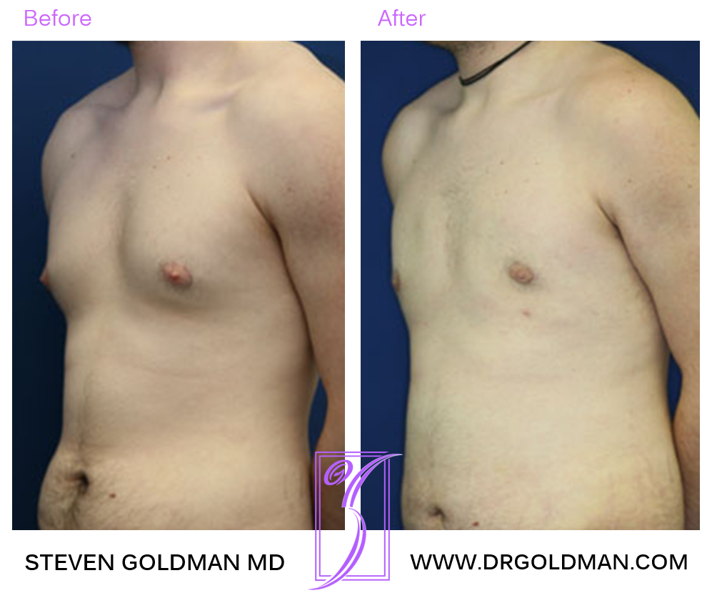 Gynecomastia