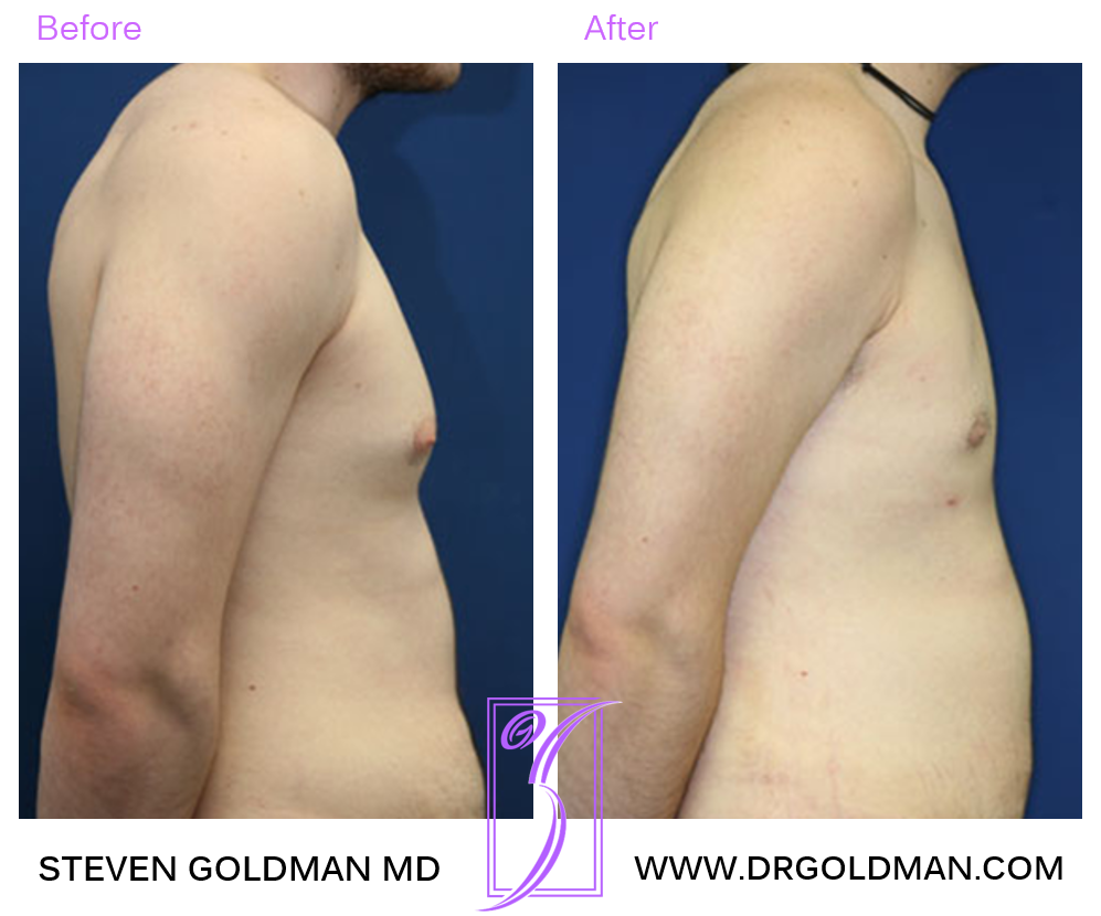 Gynecomastia
