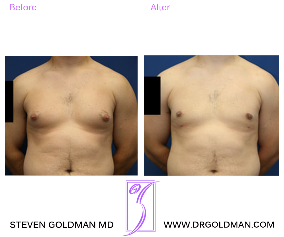 Gynecomastia
