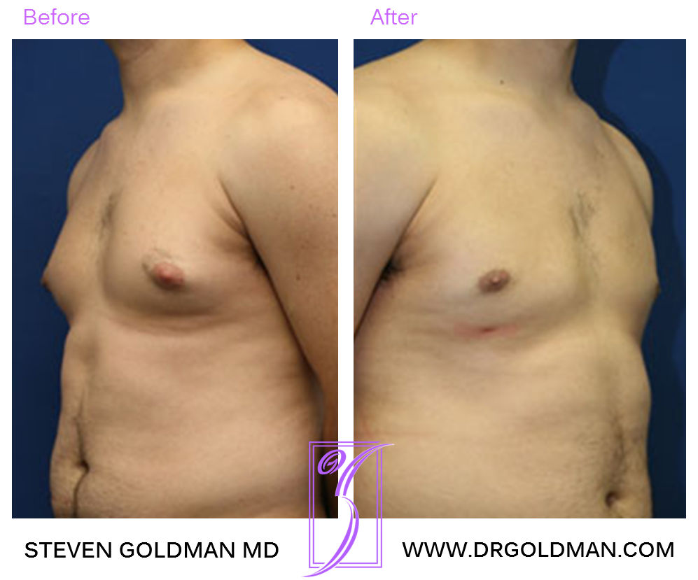 Gynecomastia