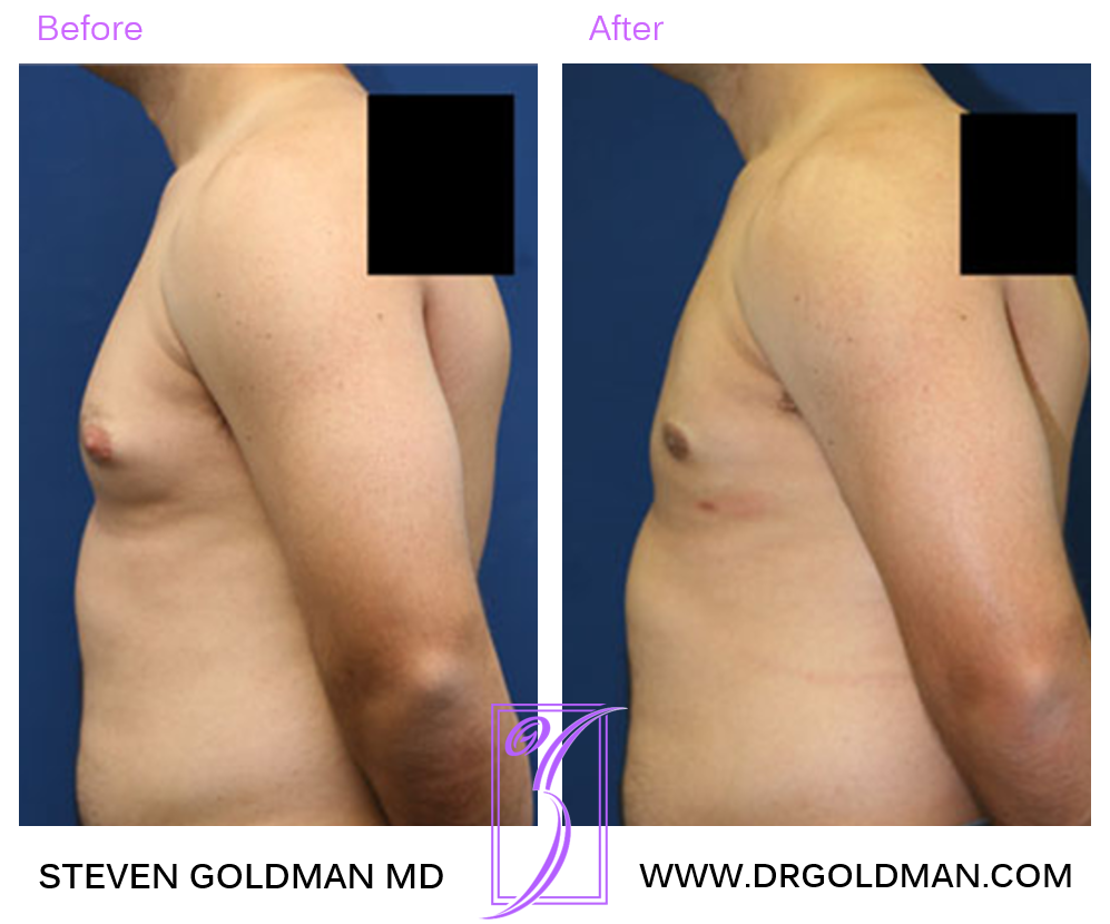 Gynecomastia