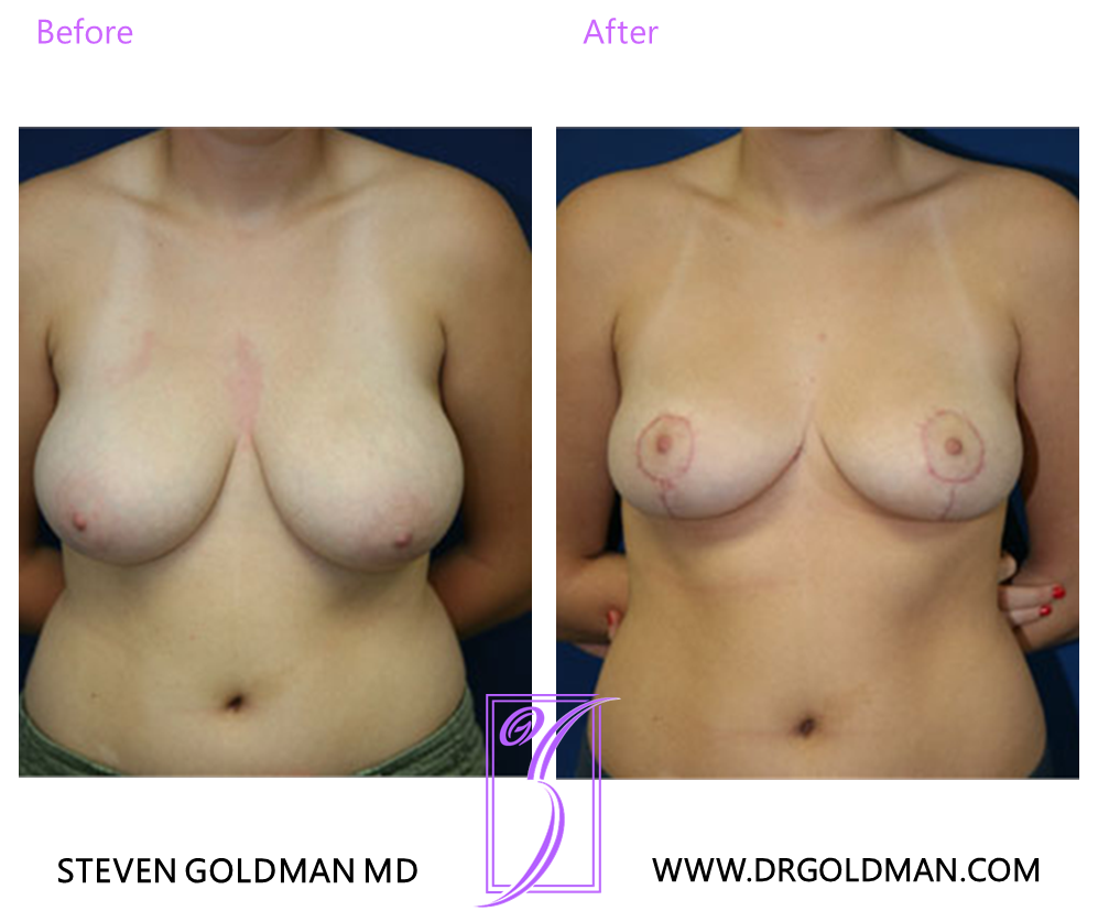 Breast Reduction