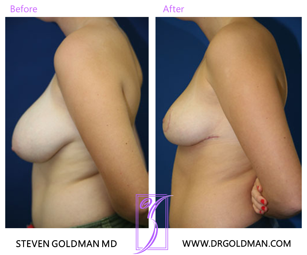 Breast Reduction