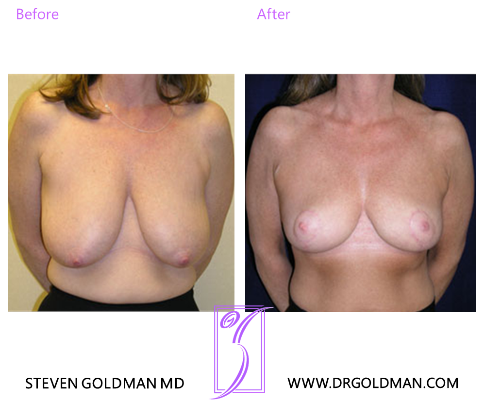 Breast Reduction