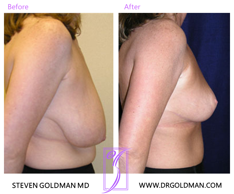Breast Reduction