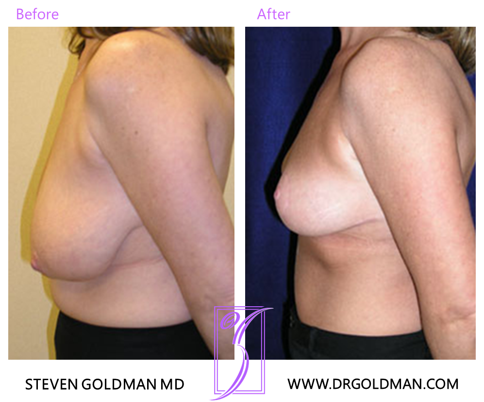 Breast Reduction