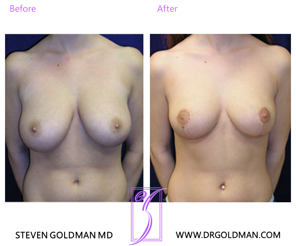 Breast Reduction