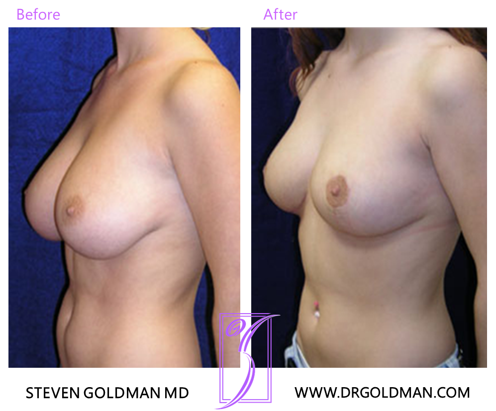 Breast Reduction