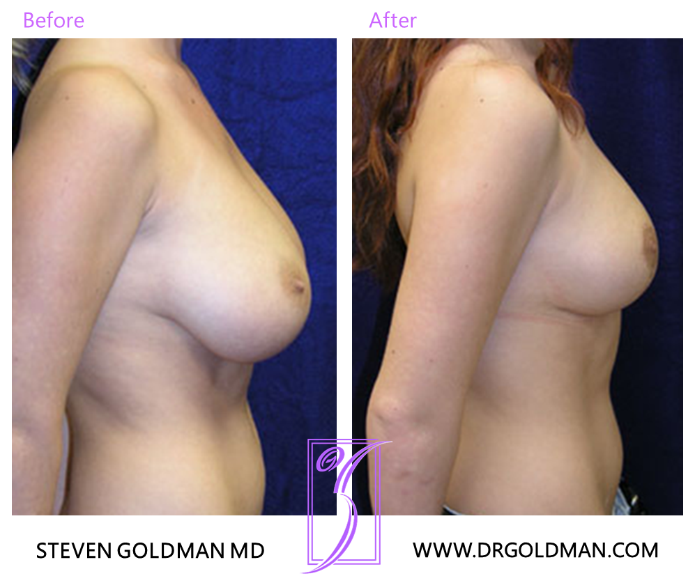 Breast Reduction