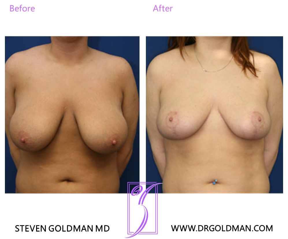 Breast Reduction
