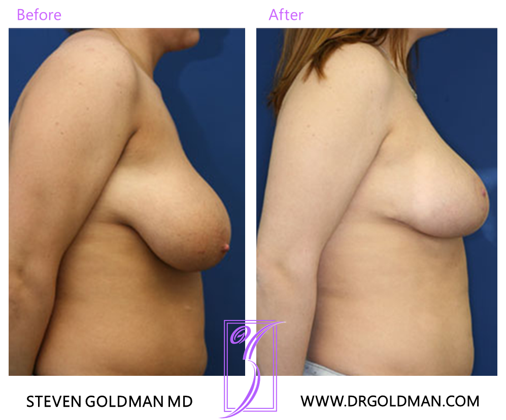 Breast Reduction