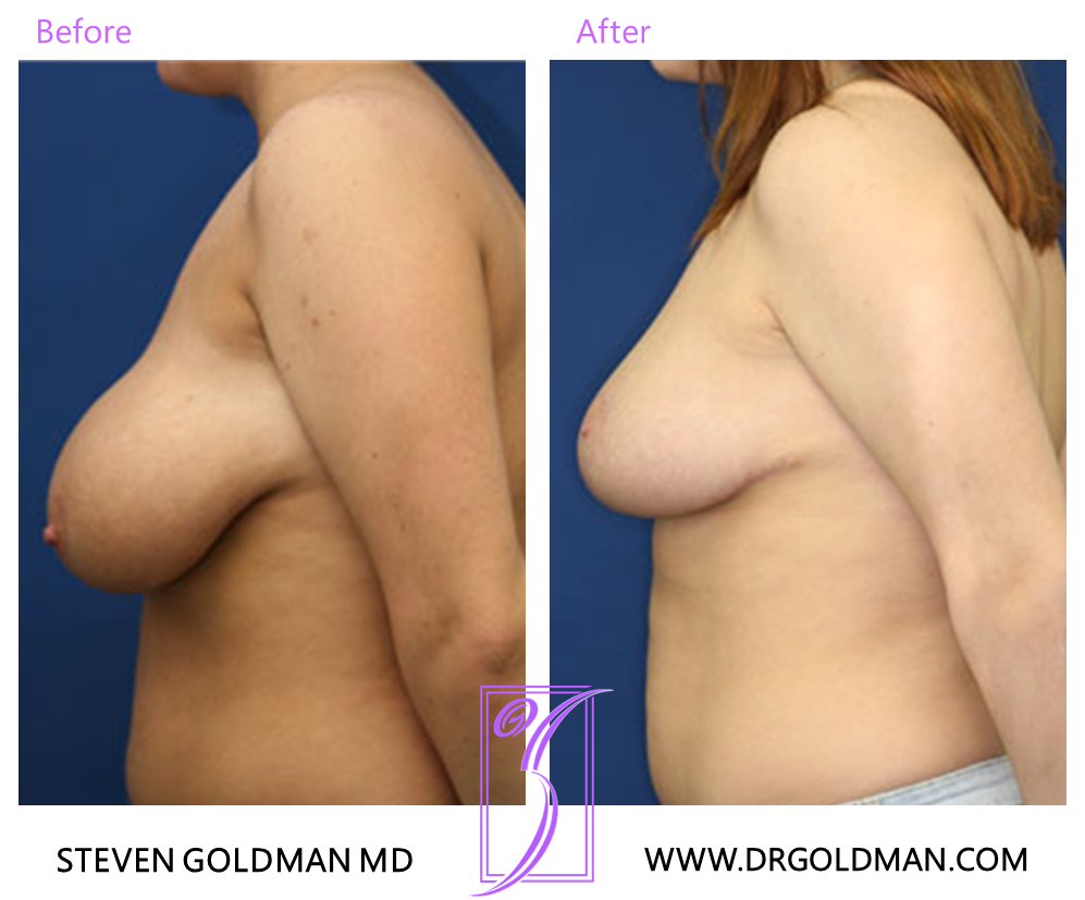 Breast Reduction