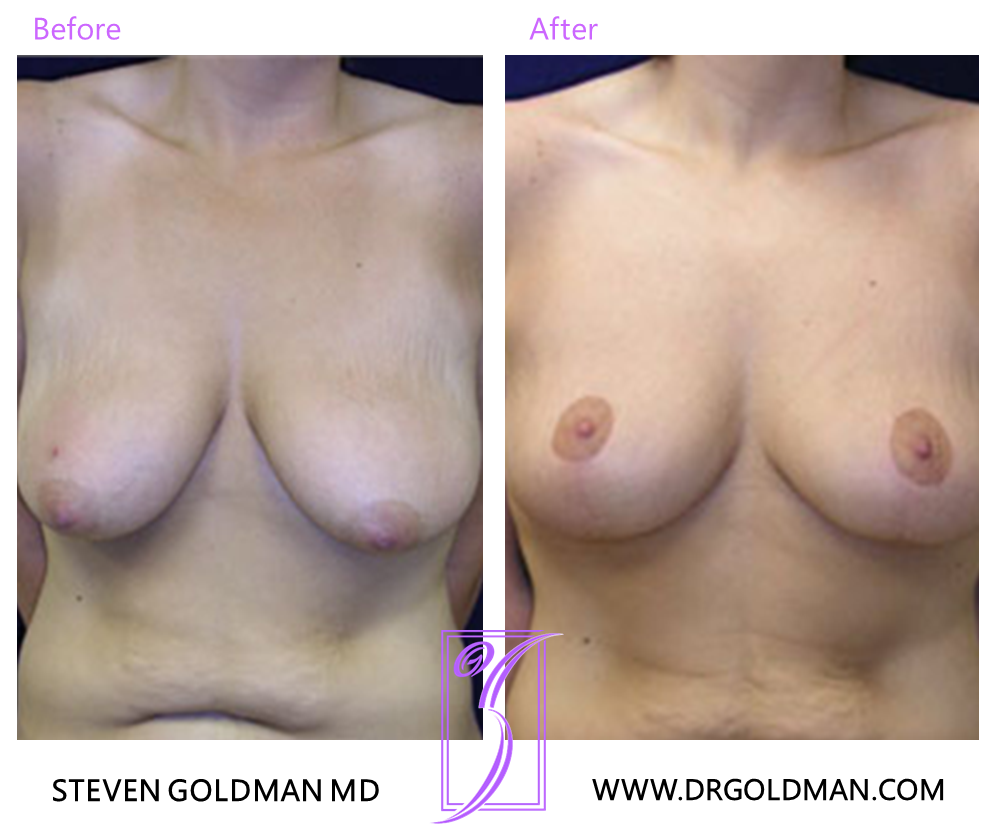 Breast Lift