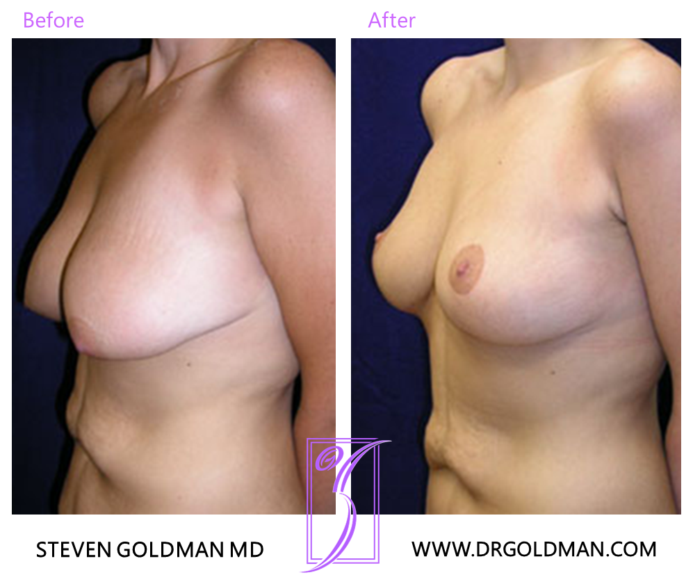 Breast Lift