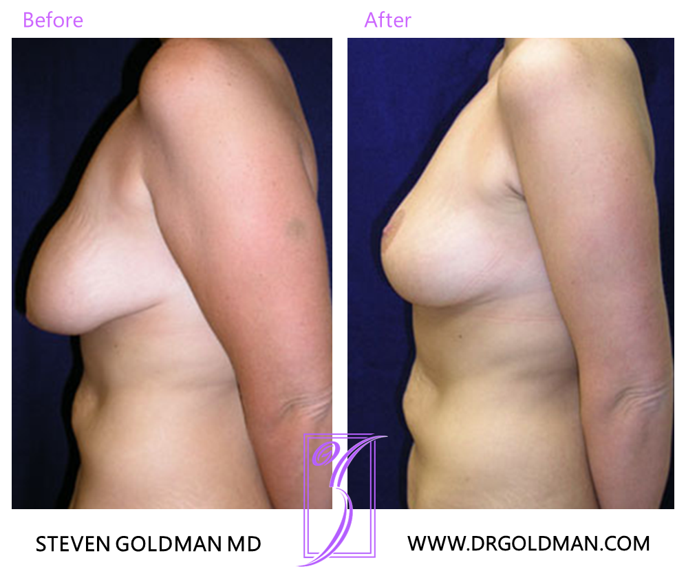 Breast Lift