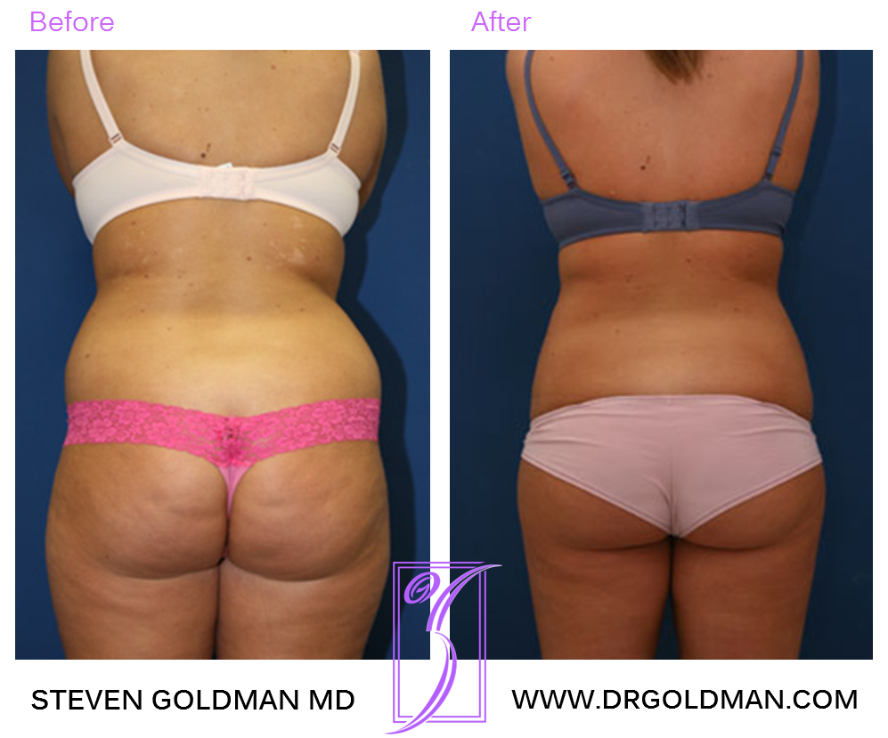 Liposuction