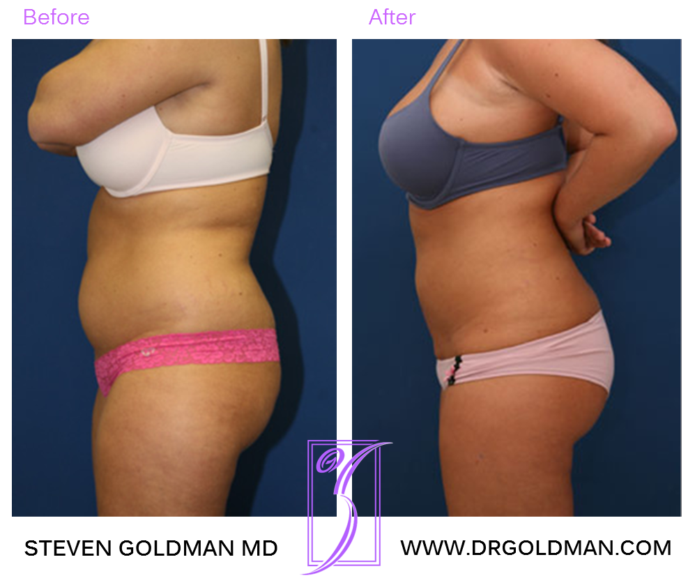 Liposuction
