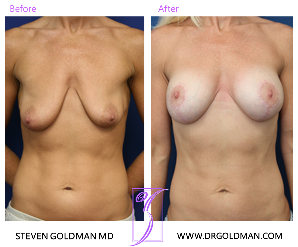 Breast Lift