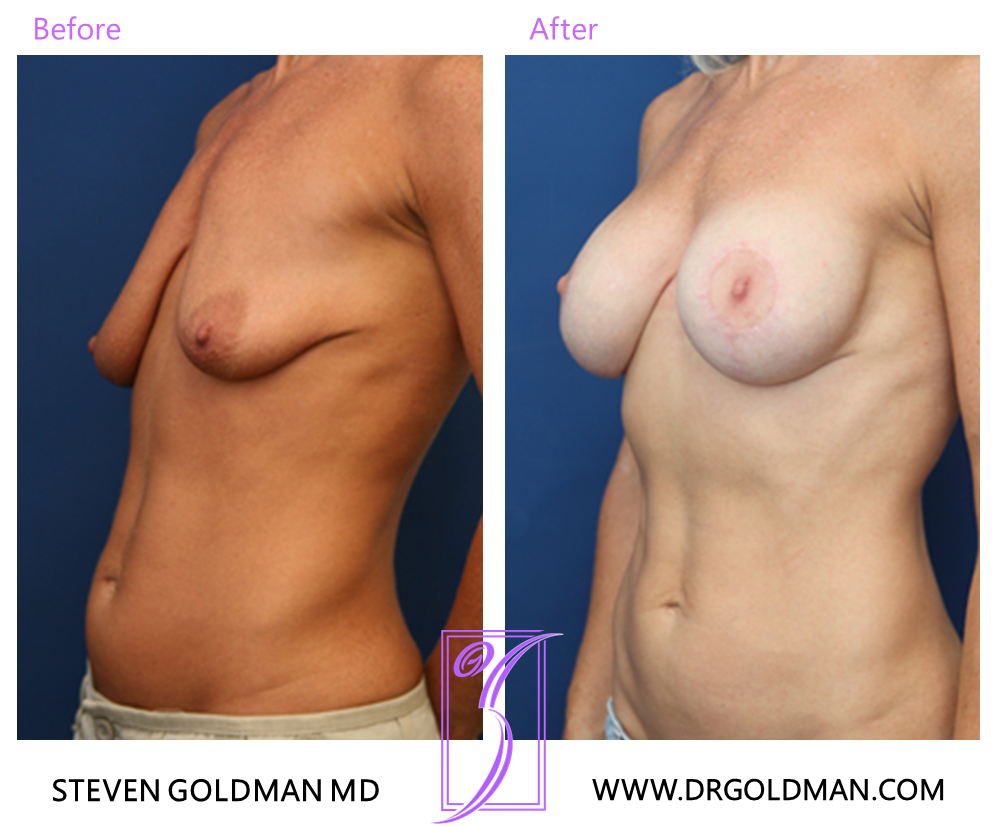 Breast Lift