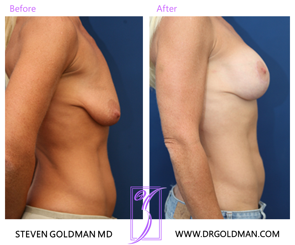Breast Lift