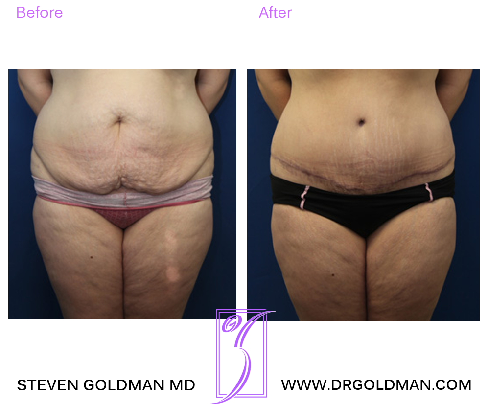 Abdominoplasty