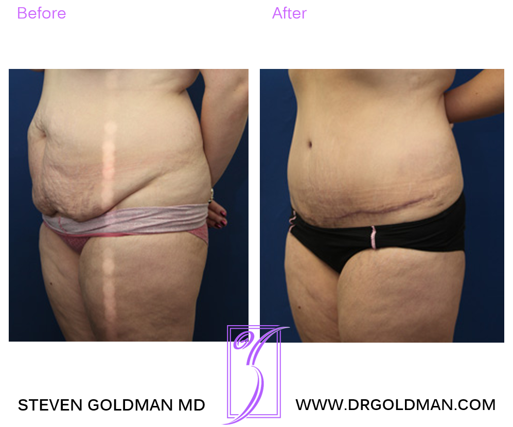Abdominoplasty