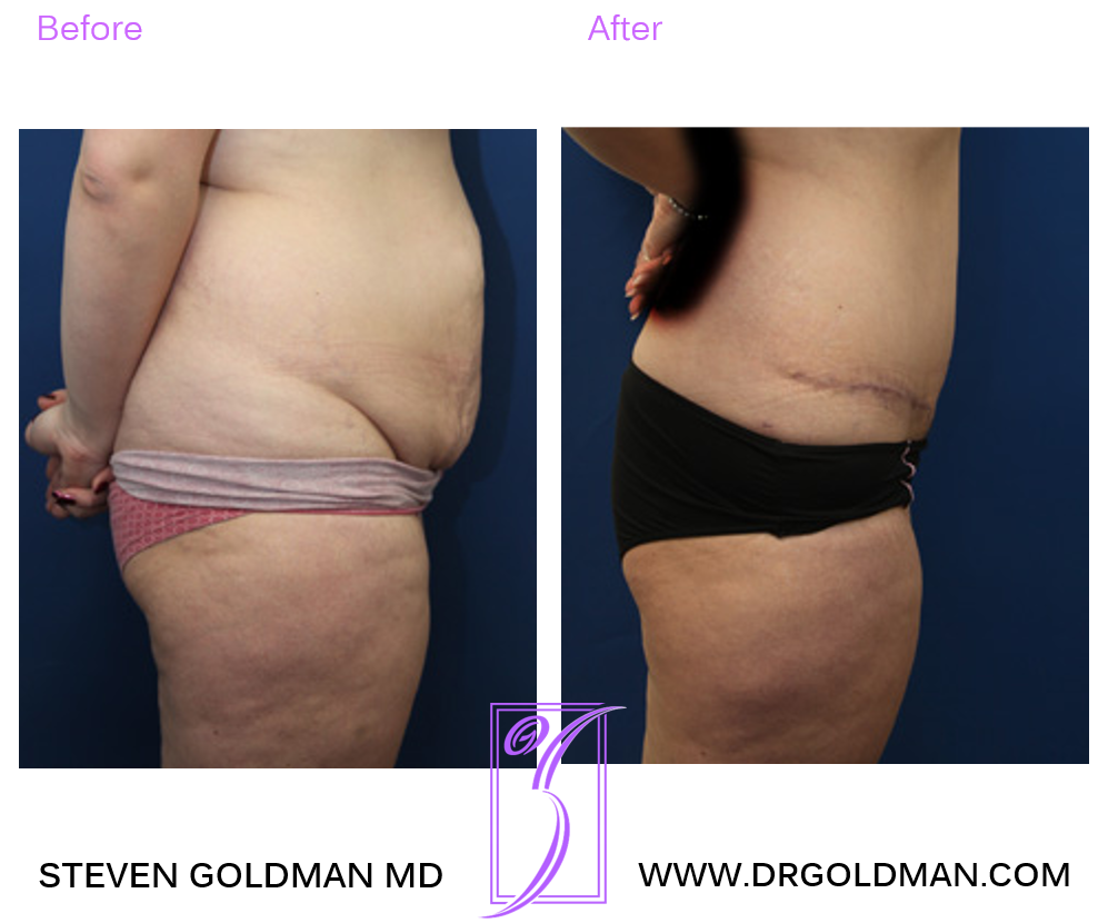 Abdominoplasty