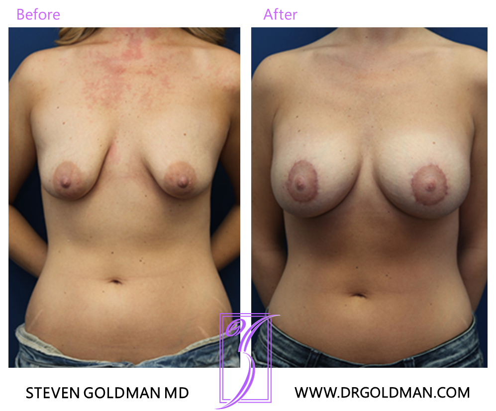 Breast Lift