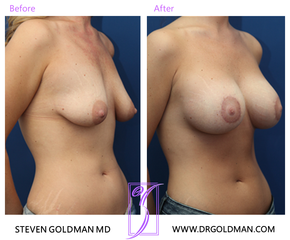 Breast Lift