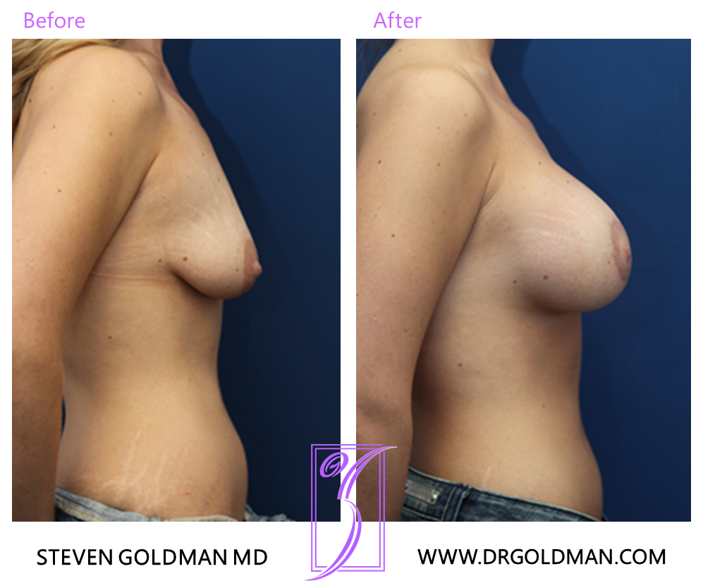 Breast Lift