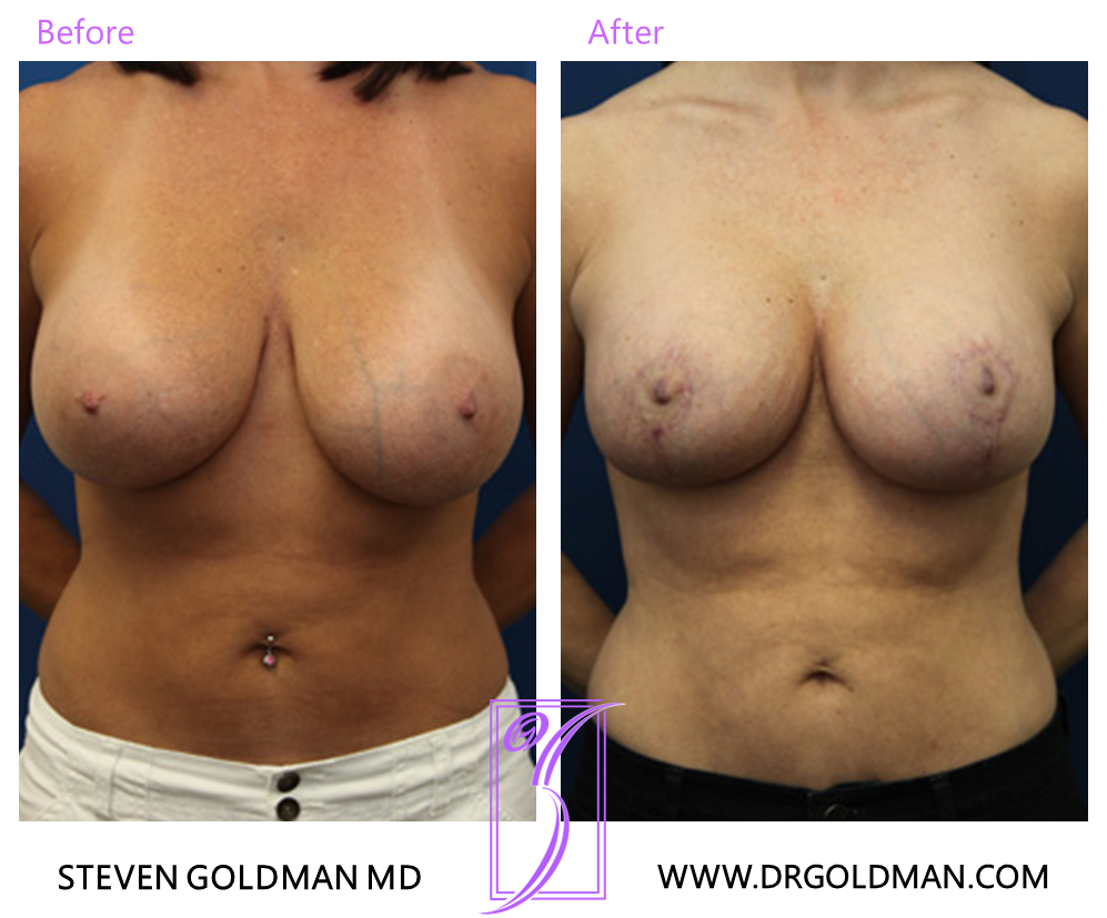 Breast Lift