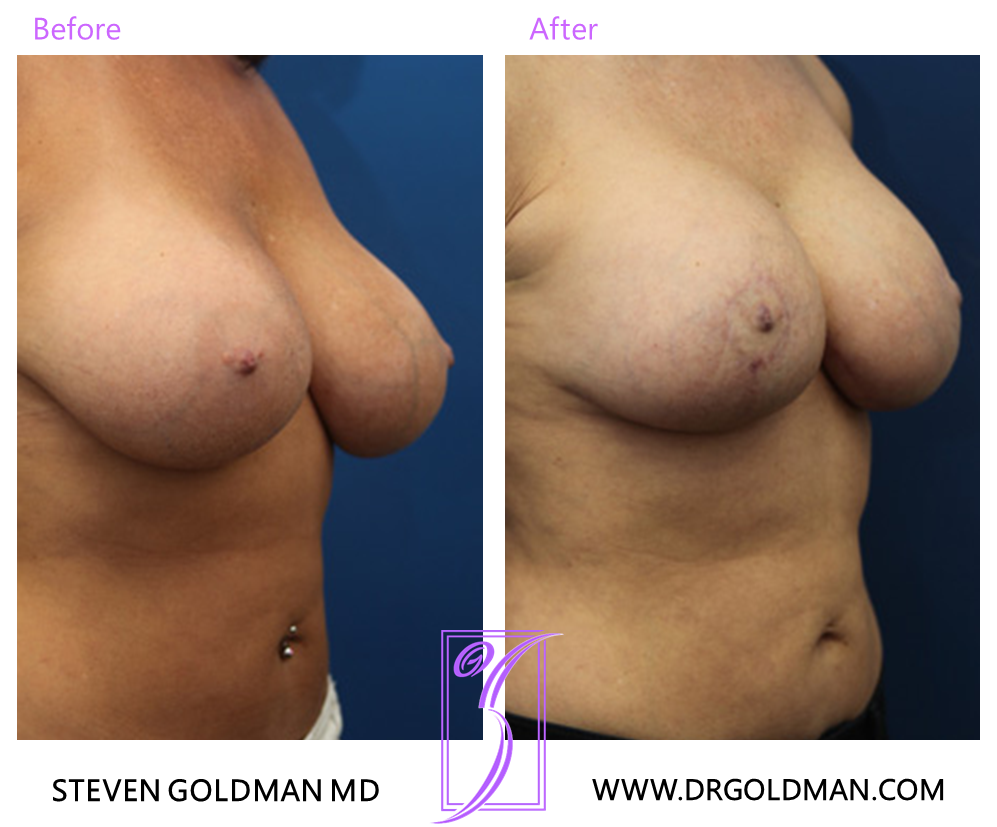 Breast Lift