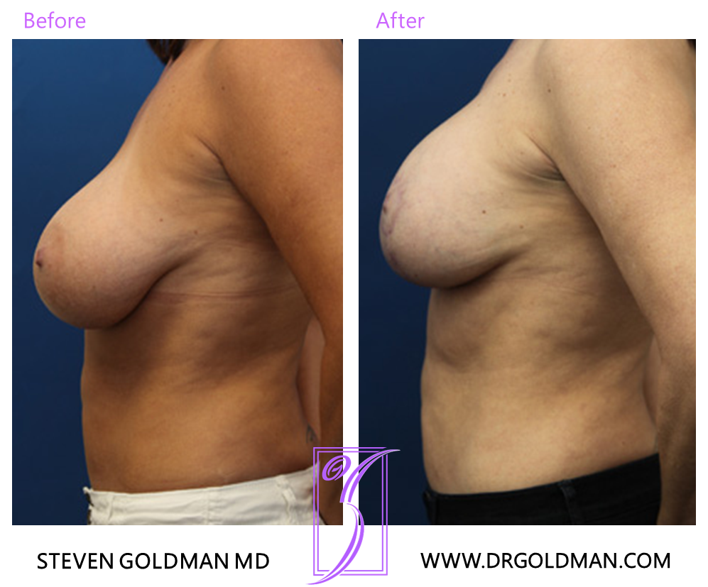 Breast Lift