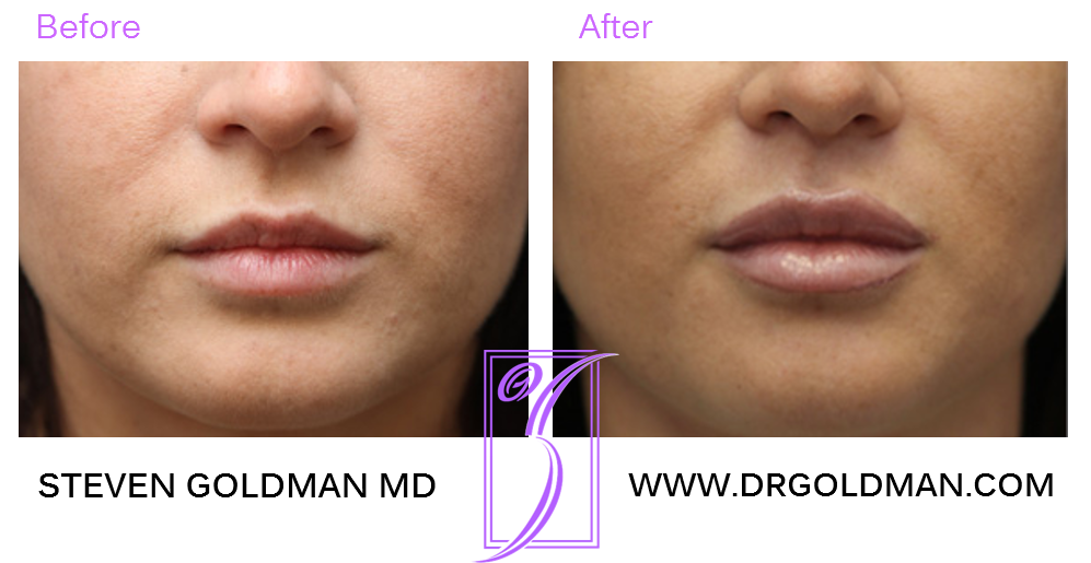 Lip Enhancement